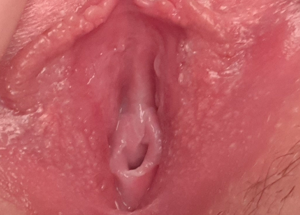 Hymen looking bulge on anus